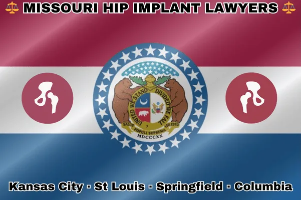 MISSOURI HIP IMPLANT LAWYERS: Kansas City, St Louis, Springfield, and Columbia text on MO state flag with hip replacement devices near a ring of stars featuring two grizzly bears, a shield, and crescent moon, all on a red, white and blue background.